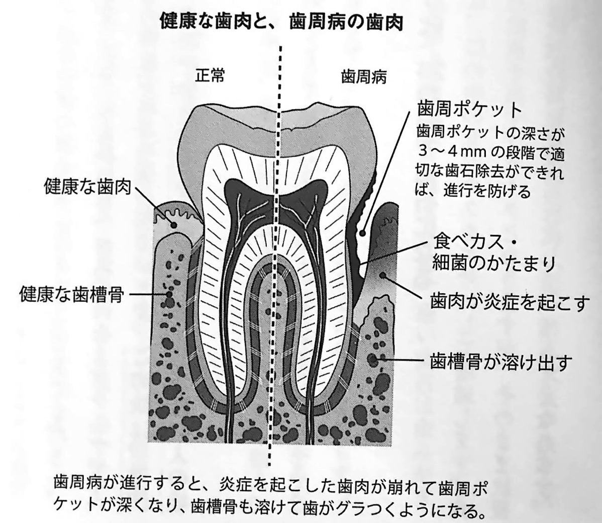 図3 健康な歯肉と 歯周病の歯肉 歯を守りなさい 第2章